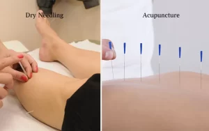 Dry Needling