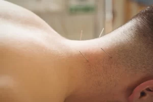 Dry Needling